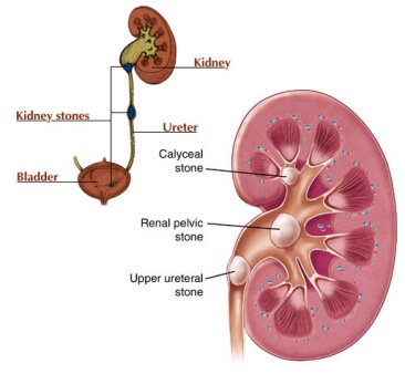 kidney-stone